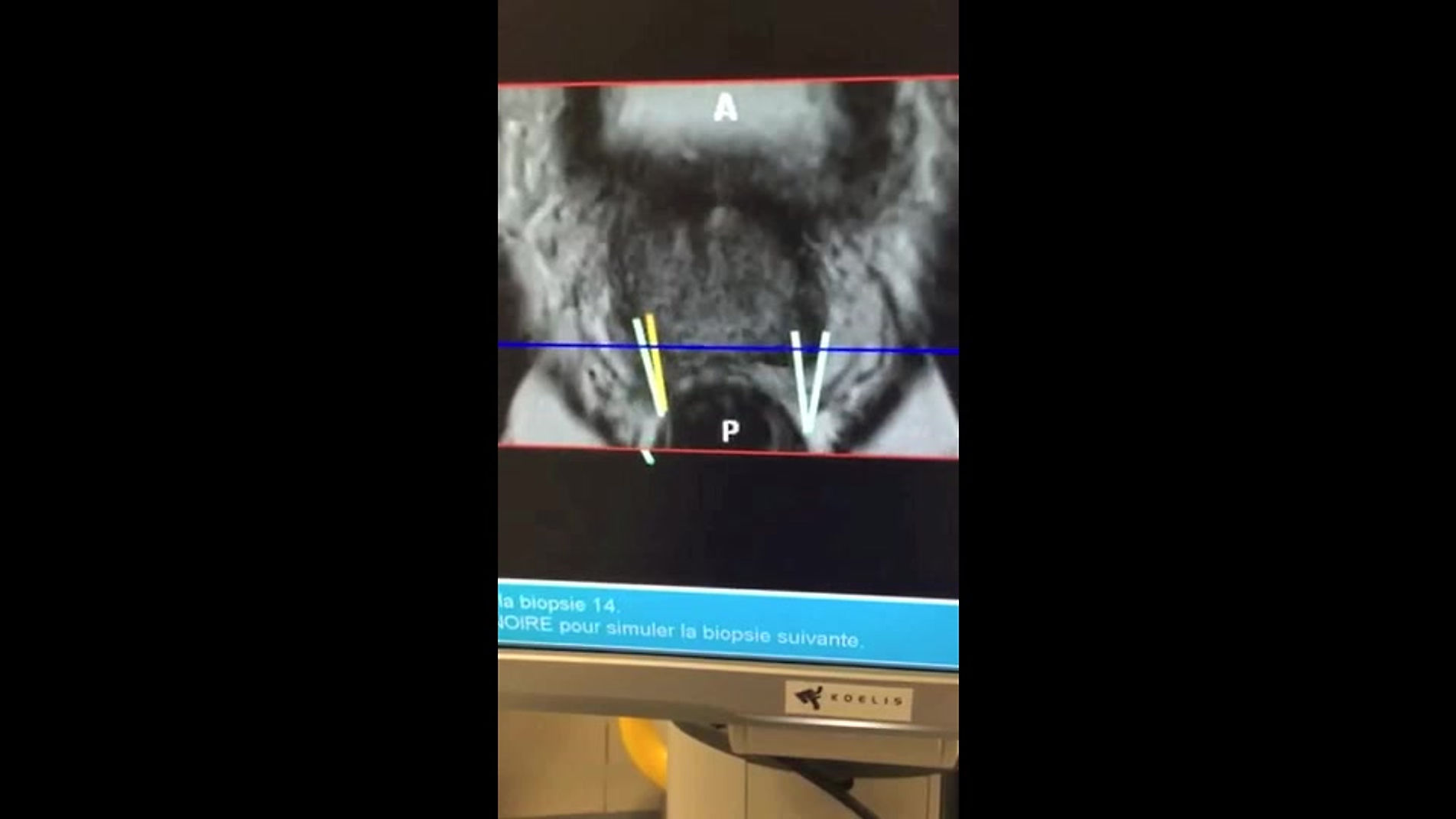 Ponction biopsies de prostate ciblées en fusion IRM/écho
